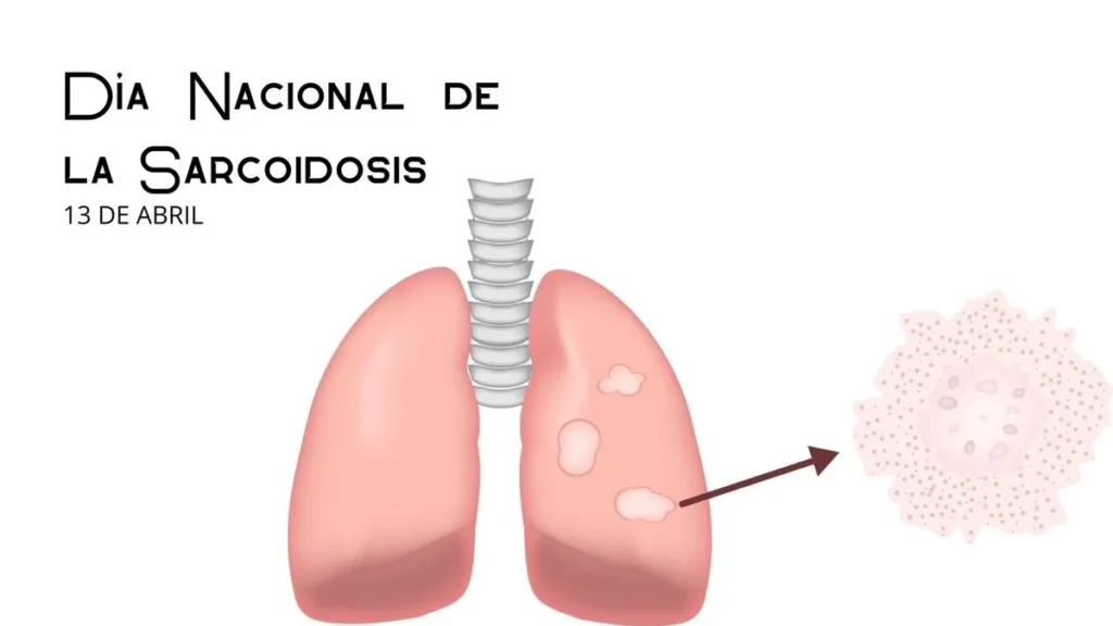 Día Nacional de la Sarcoidosis: Concientización y apoyo